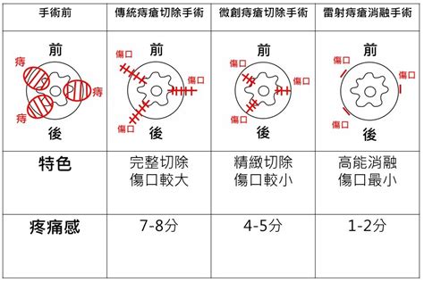 內外痣|痔瘡的治療原則與方法